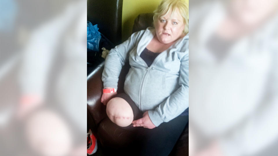 Mutter (43) schneidet sich beim Rasieren – und verliert ihr Bein Tanya Czernozukow
