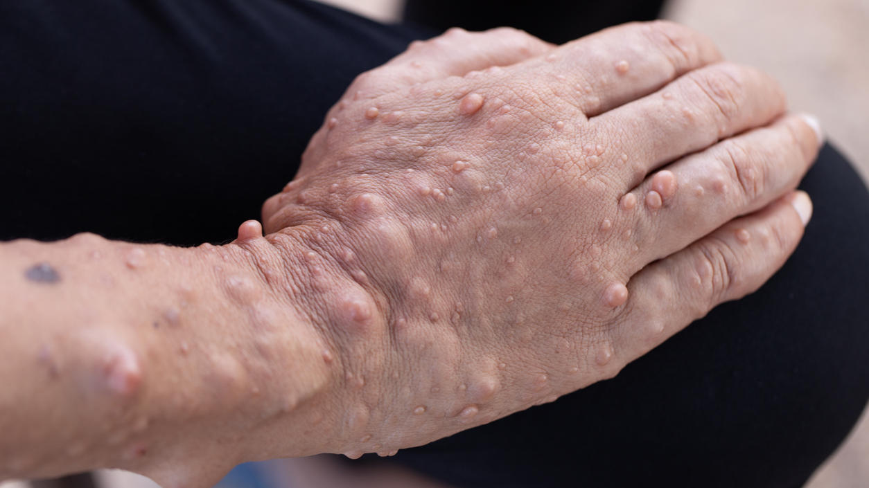 Gesundheitslexikon: Neurofibromatose Symptom von Neurofibromatose: Eine Hand mit vielen kleinen Geschwülsten unter der Haut