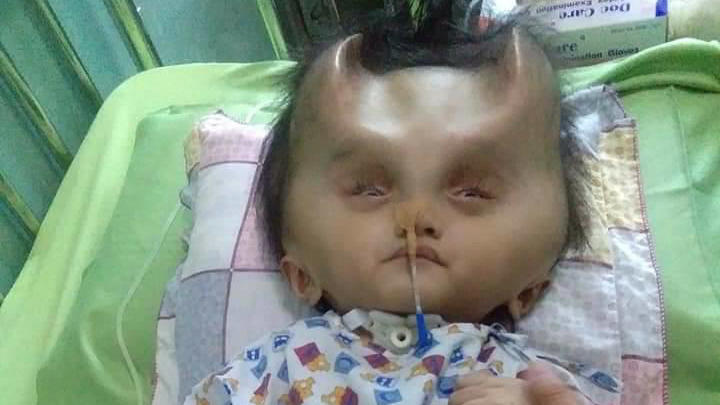 Seltene Fehlbildung Hydranencephalie: Mutter kämpft um Baby mit "Teufelshörnern" NEWS COPY - WITH VIDEO AND PICTURESThis toddlers battling a rare brain condition has been left with real-life DEVIL HORNS after a botched operation.Twenty-two month old Clyne Solano suffered from congenital hydranencephaly in the womb which prevented