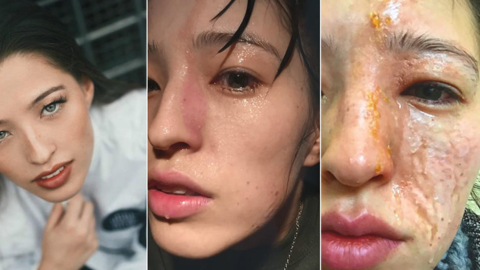 Eine Duftlampe hat Emilys Gesicht so verletzt Eine Duftlampe hat Emilys Gesicht so verletzt
