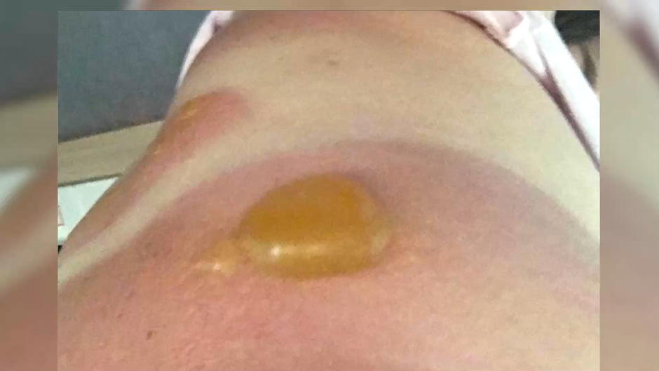 Sarah trägt heftige Brandblase davon Sarah trägt heftige Brandblase davon