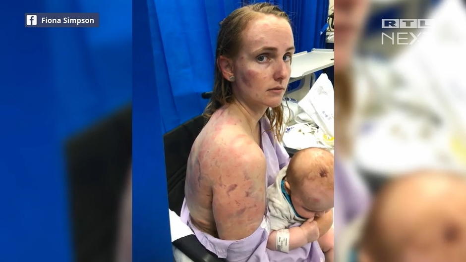 Mutter beschützt ihr Baby vor riesigen Hagelkörnern Mutter beschützt ihr Baby vor riesigen Hagelkörnern