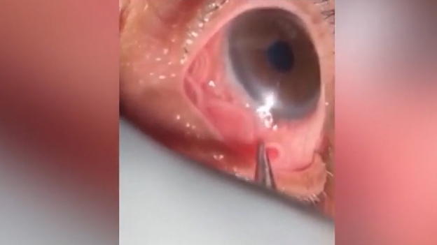 Schrecklich: Dieser Mann hat einen Wurm im Auge Schrecklich: Dieser Mann hat einen Wurm im Auge