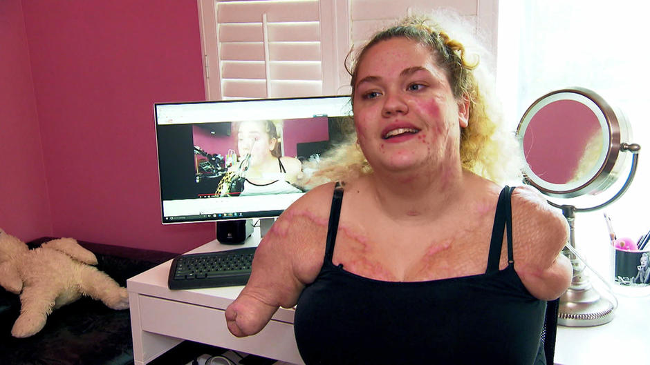Ohne Arme und Beine Kaitlyn hat ihren Lebensmut nicht verloren